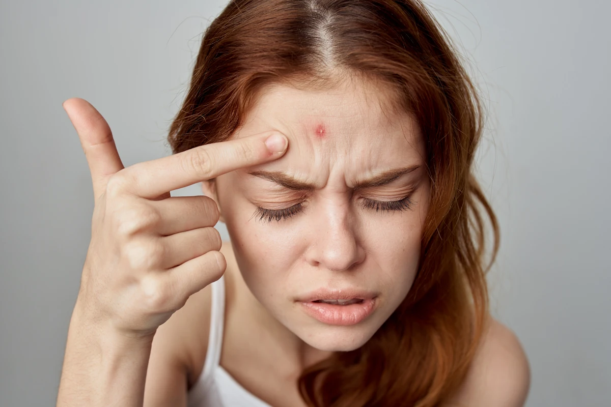 Une femme qui a un bouton douloureux sur le front